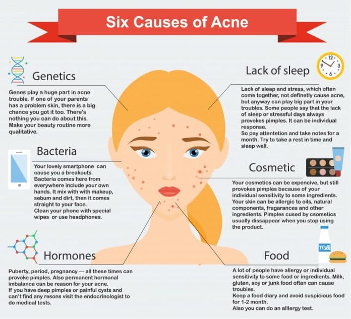 what causes acne and how can i prevent it 2