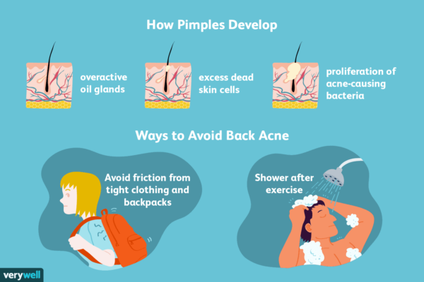 What Causes Acne And How Can I Prevent It?
