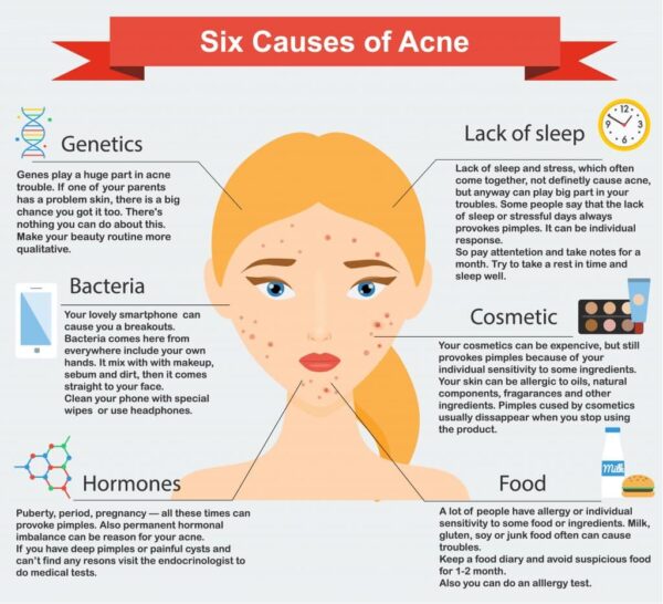 What Causes Acne And How Can I Prevent It?