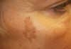 how can i lighten age spots naturally